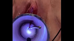 Inserting sound into cervix Thumb